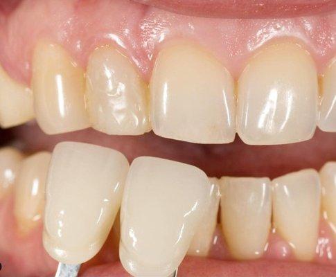 Perfect color matching at Greenwich Cosmetic Dentistry