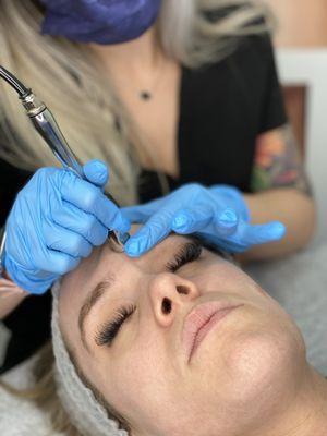 Diamond Tip Microdermabrasion