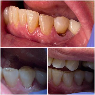 Class V (when you have cavity in the gum line area) filling - Clase V (cuando la caries esta en la linea de la encilla) relleno/empaste.