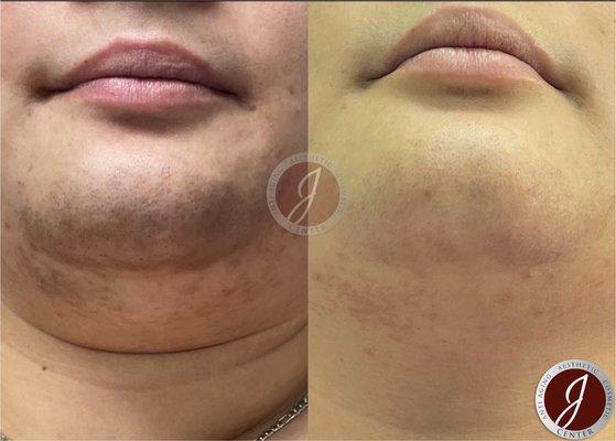 Chin Laser Hair Removal