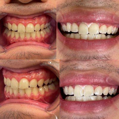 TEETH WHITENING 
Instant results in less than 60 minutes