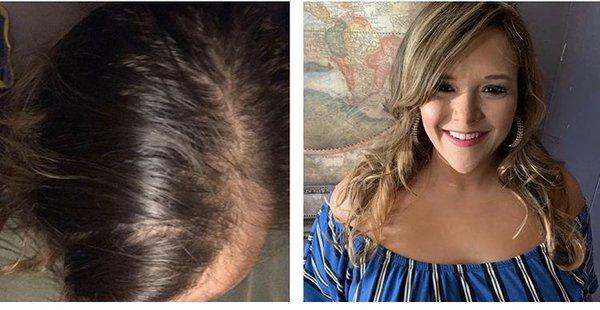 Before and after hair loss replacement