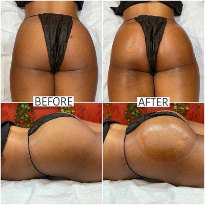 Non surgical butt lift