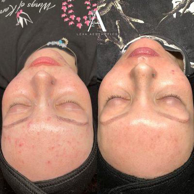 Acne Bootcamp Results