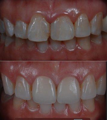 Two crowns on front teeth with gum surgery