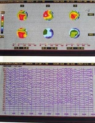 19 Electrode QEEG Brainmap.  Lower shows raw trace of activity.  Upper shows strength of this across the head.