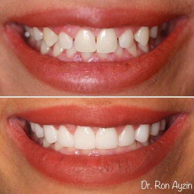 This patient didn't like her small teeth and spaces. 10 veneers gave her the amazing smile she was looking for!