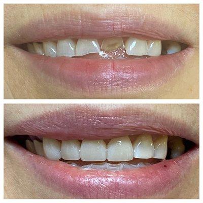 Before and after 4 crowns ( to save the teeth from further wear ) !