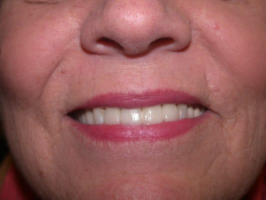 This patient had her front tooth removed.  She was not a candidate for an implant so an all ceramic bridge made.  A very natural result!