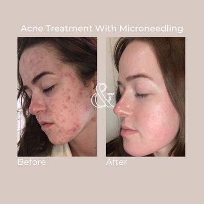 Results from acne treatment with microneedling on our patient.