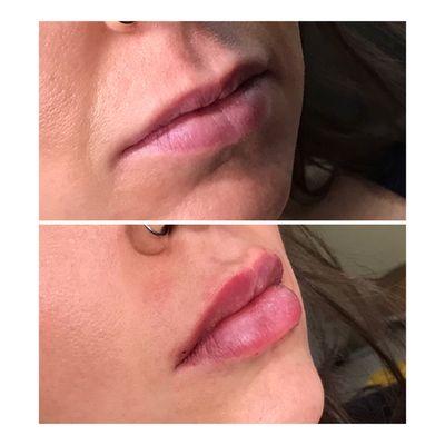 Lip filler is ideal to enhance lip shape, add hydration and provide an overall lip plump!