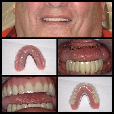 Removable implant-supported upper denture