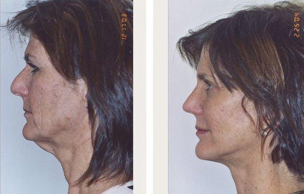 Facelift (includes neck), 4 lids, rhinoplasty