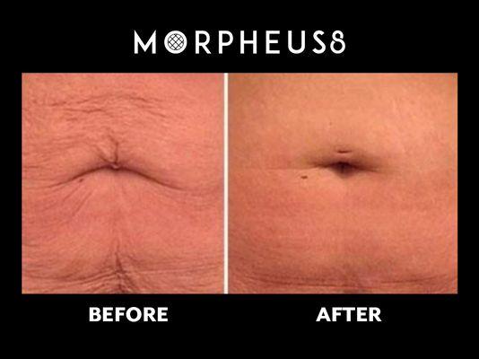 Tighten and tone loose skin with our Morpheous8 treatments done in our office! Call us at  818 342 4541 to schedule your FREE consultation.