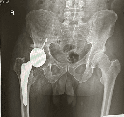 CUP FELL OUT OF THE HIP SOCKET