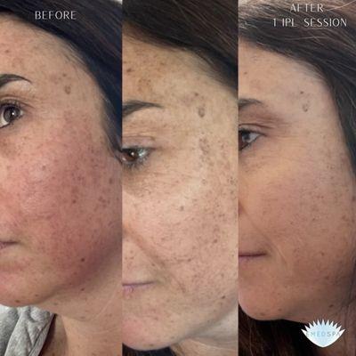 IPL PhotoFacial Treatment for Sunspots-- Results after 3 sessions