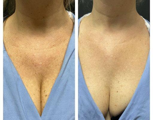 one treatment IPL chest