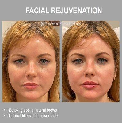 Total facial rejuvenation: neuromodulators and dermal fillers were used on the entire face