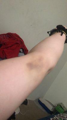 Bruising