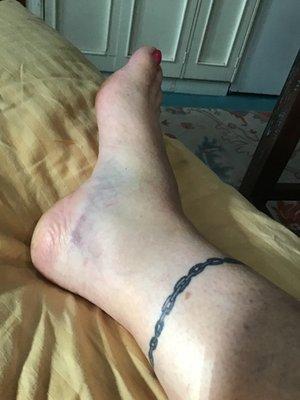 Fractured right ankle fibula