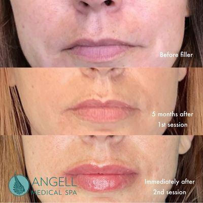 Lip Filler Progression with each session. Natural results