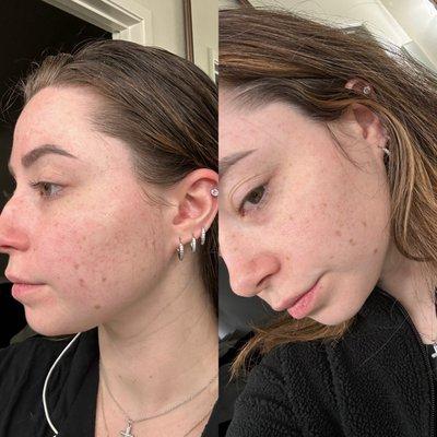 Before & After customized skin care routine