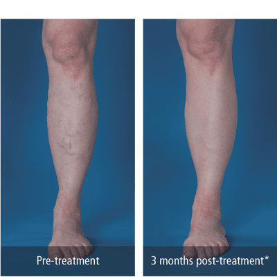 VenaSeal is a newer vein treatment that is minimally invasive, little downtime, and great results.