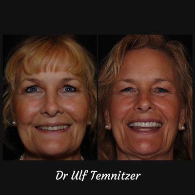 Gorgeous full mouth rehabilitation by Dr Temnitzer