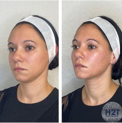 Cheek Filler before and after