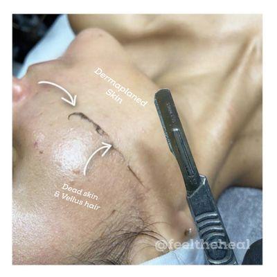 Dermaplaning