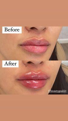 Lip filler