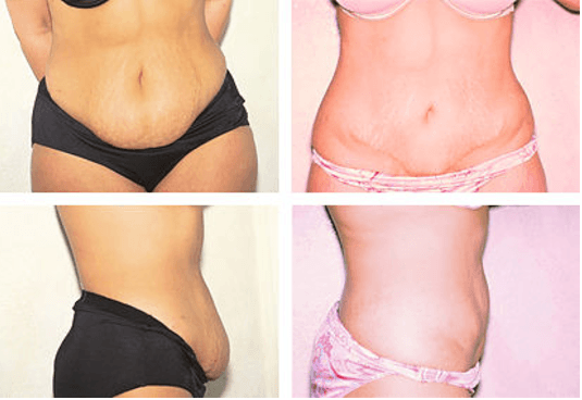 Tummy tuck. 40-45 year old female.