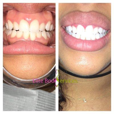 Our Goal is to give you a Bright smile (Teeth Whitening)