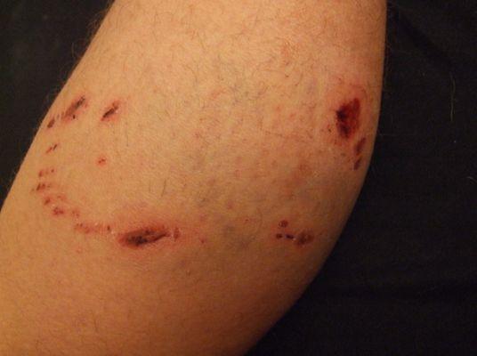 Photo after dog attacked my dog and I intervened. This is what it looks like before your dog gets euthanized