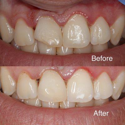 Chipped tooth?
We can fix it with a simple bonding just in minutes!