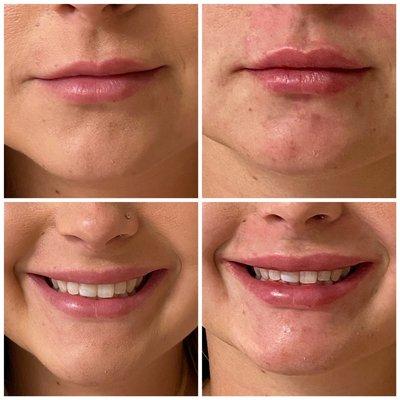 1 syringe Juvederm