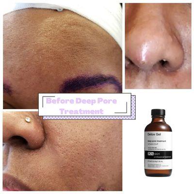 Detox Gel Pore Treatment