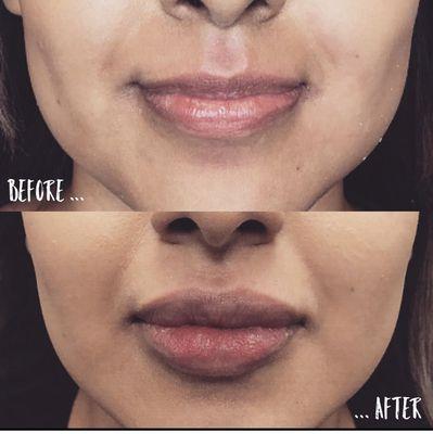 Lip filler