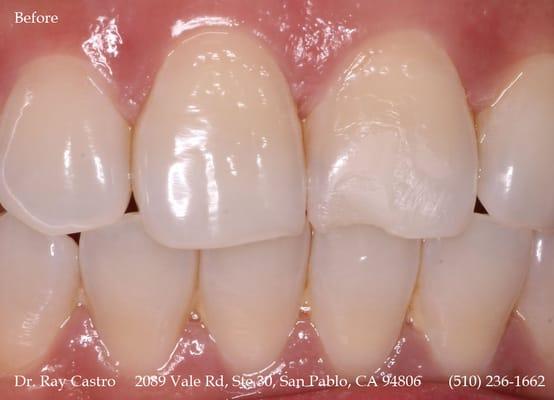 (before) Many times a front tooth can be fixed very easily on the same day without any discomfort. This is an actual patient of Dr. Castro.