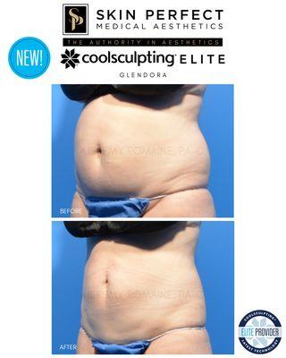 CoolSculpting Elite is a game changer!