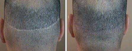 Hair transplant scar camouflage with simulated hair.