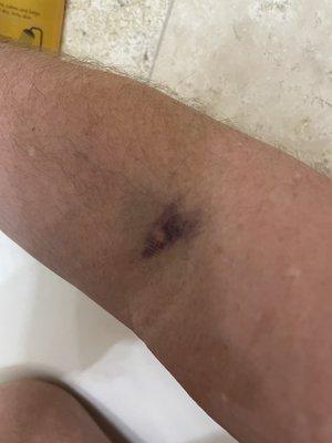 Hematoma