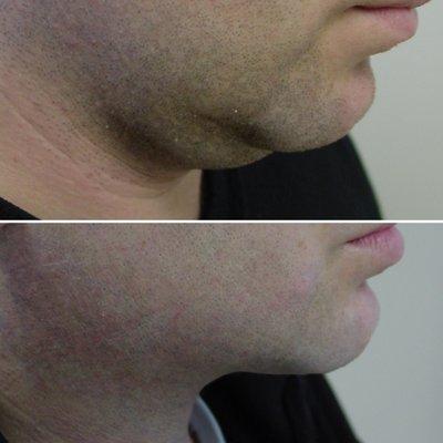 Smart Liposuction removes fat while tightening skin. Here is a before and after of a disappearing double-chin.