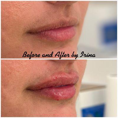 Lips filler