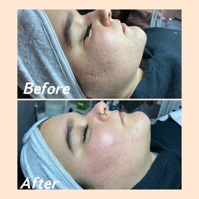 Deep facial with dermaplaning