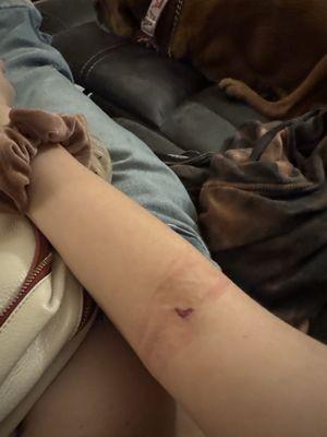 My arm after bloodwork