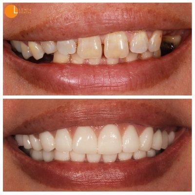 A truly life-changing transformation with orthodontics, surgery, implants, and crowns.