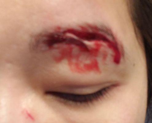 Eyebrow Laceration - Before