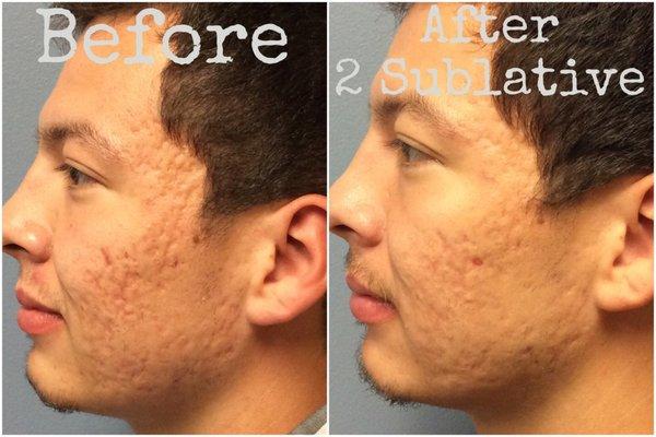 We offer Sublative laser to help with acne scars.