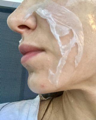 CHEMICAL PEEL